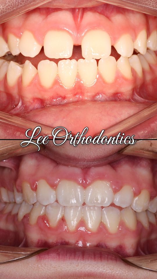 Orthodontic case 2: teeth before and after treatment