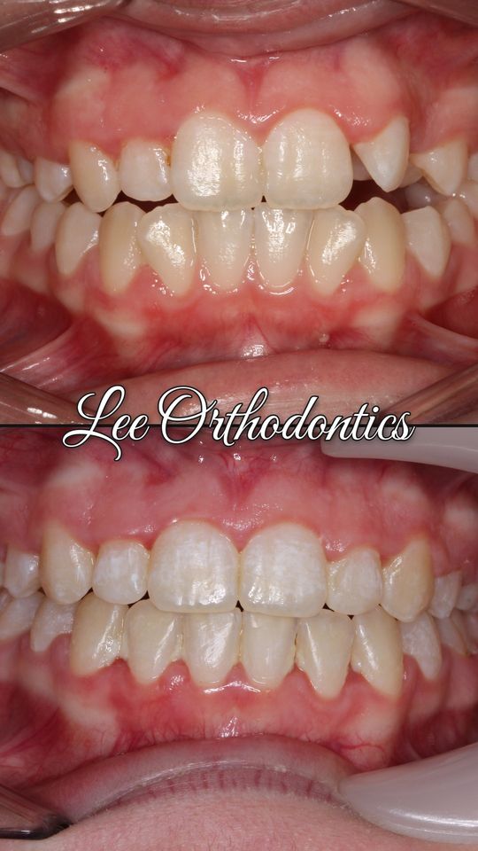Orthodontic case 3: teeth before and after treatment