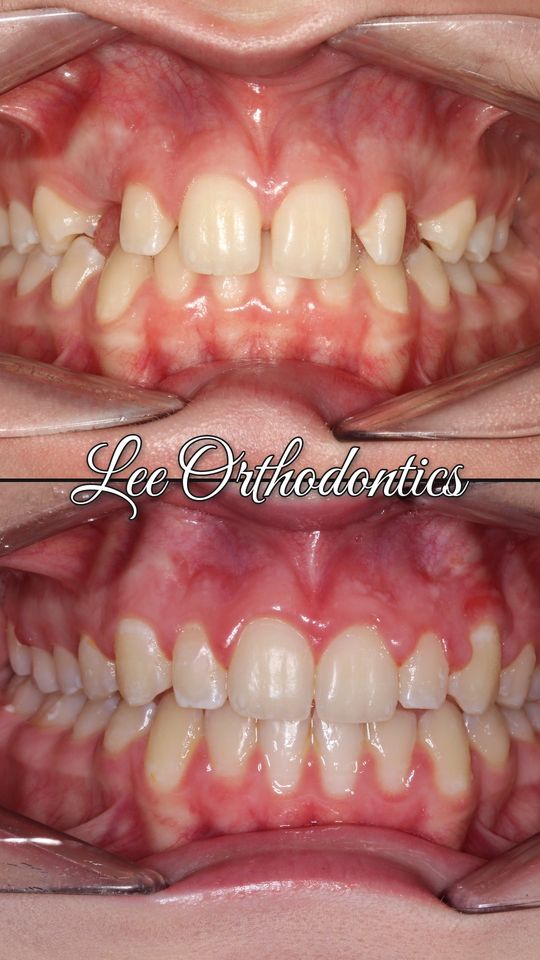 Orthodontic case 7: teeth before and after treatment