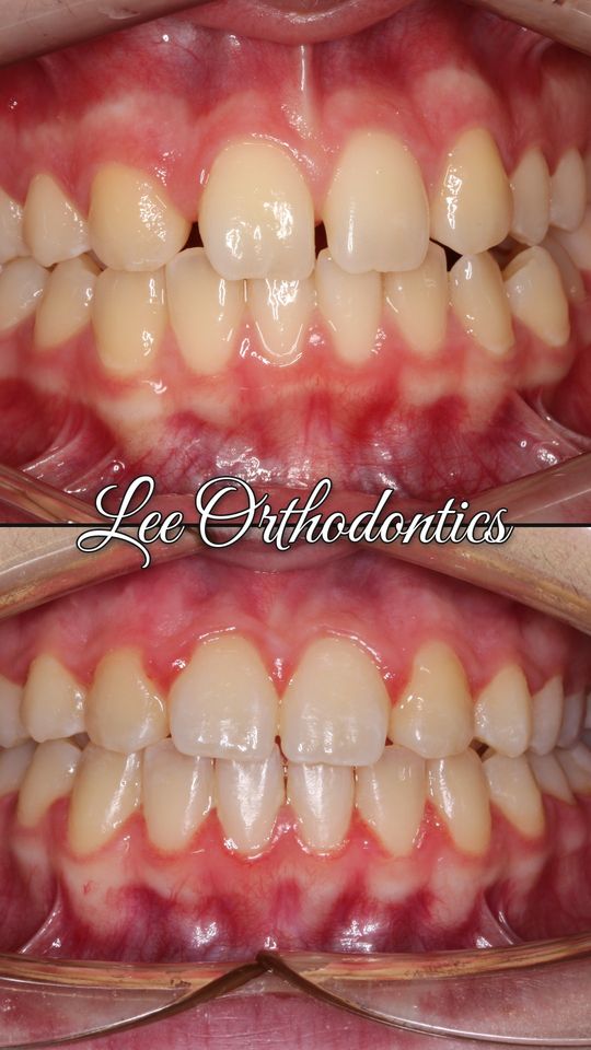 Orthodontic case 8: teeth before and after treatment
