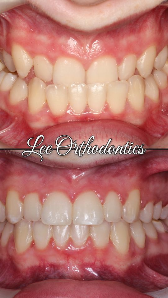 Orthodontic case 9: teeth before and after treatment