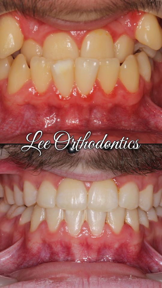 Orthodontic case 12: teeth before and after treatment