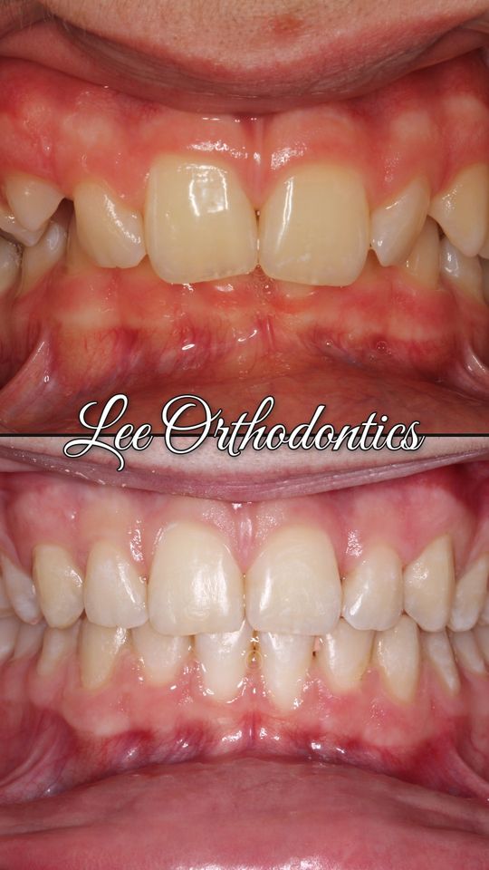 Orthodontic case 13: teeth before and after treatment