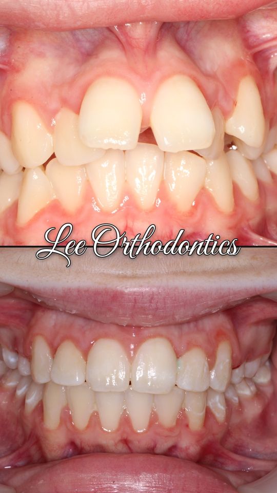 Orthodontic case 14: teeth before and after treatment