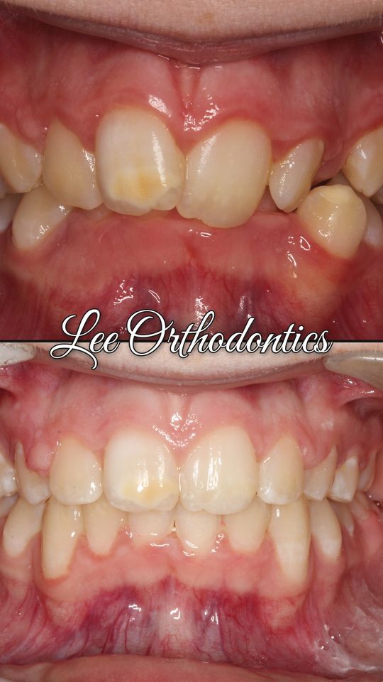 Orthodontic case 15: teeth before and after treatment