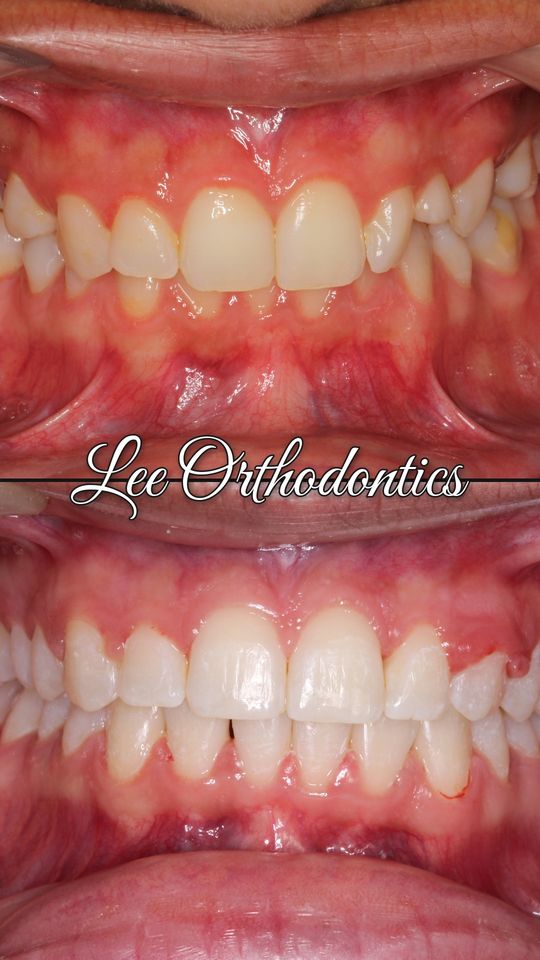 Orthodontic case 16: teeth before and after treatment
