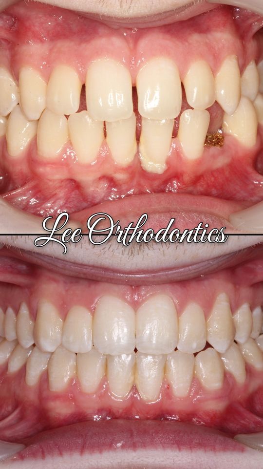 Orthodontic case 17: teeth before and after treatment