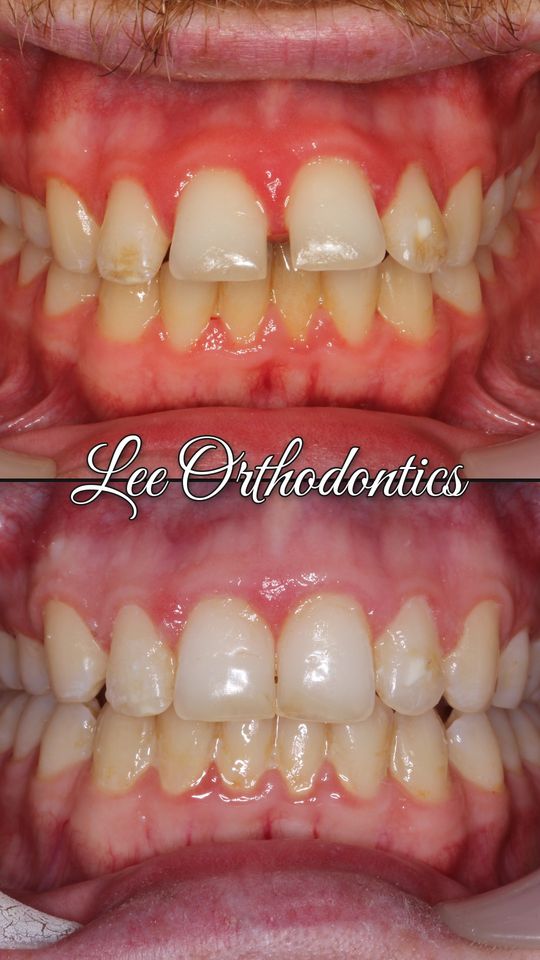 Orthodontic case 18: teeth before and after treatment
