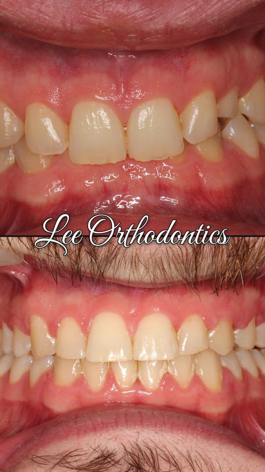 Orthodontic case 19: teeth before and after treatment